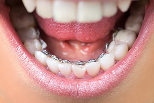 すきっ歯はどうやって治療するの？