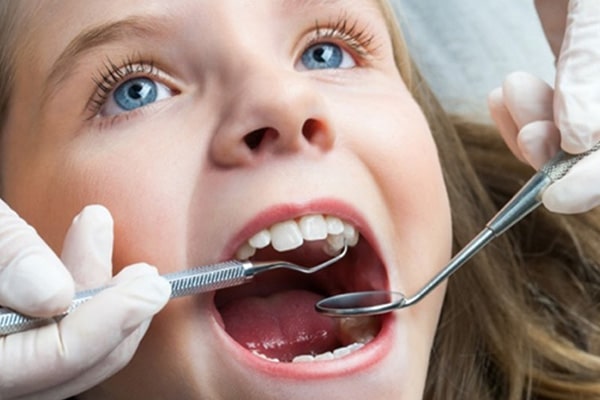 すきっ歯の治療期間はどのくらい？