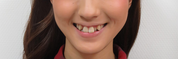 八重歯の例