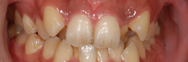 八重歯の例2
