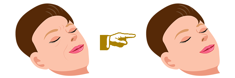 ボトックス注射