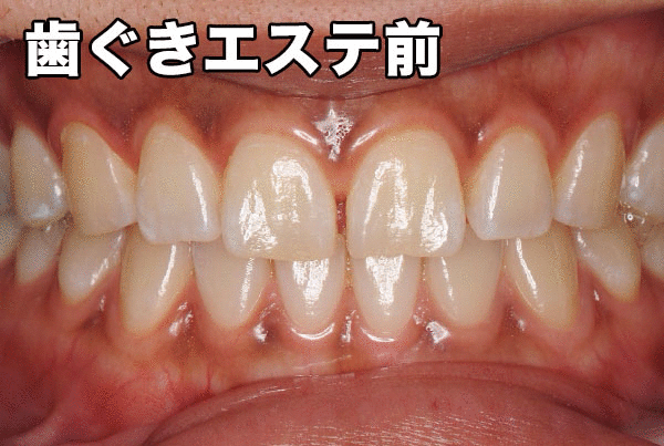 歯ぐきピーリング
