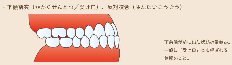 下顎前突