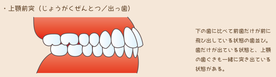 上顎前突