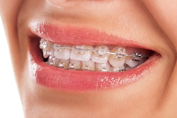 すきっ歯はどうやって治療するの？