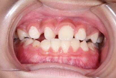 子供のすきっ歯治療はどんなことをするの？