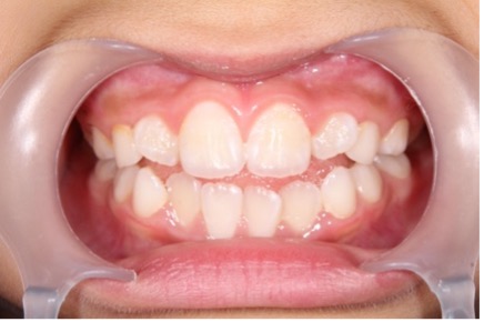 子供のすきっ歯治療はどんなことをするの？