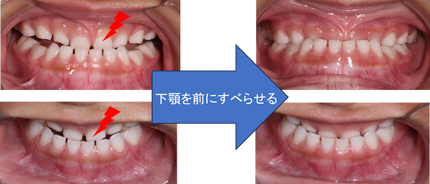 そもそもなんで受け口になるの？