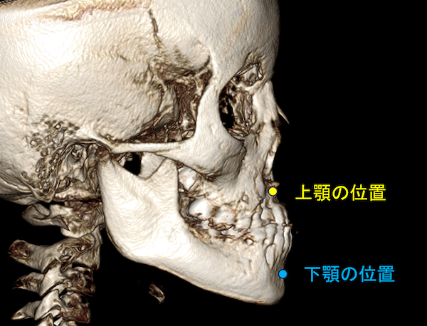 子供の受け口治療はどんなことをするの？